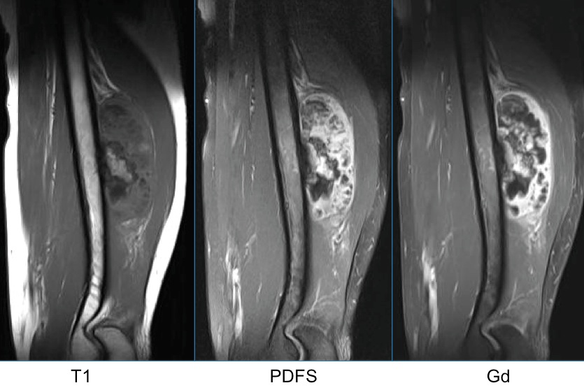 Figure 2 for case Parosteal osteosarcoma ( RID4021 )